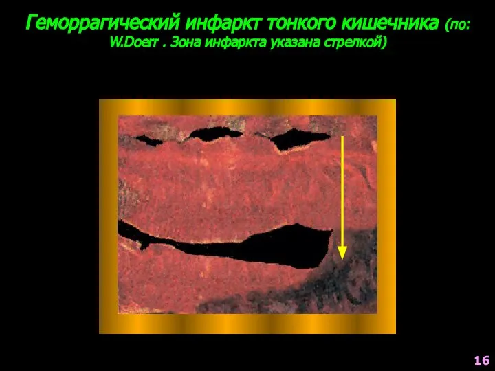 Геморрагический инфаркт тонкого кишечника (по: W.Doerr . Зона инфаркта указана стрелкой) 16