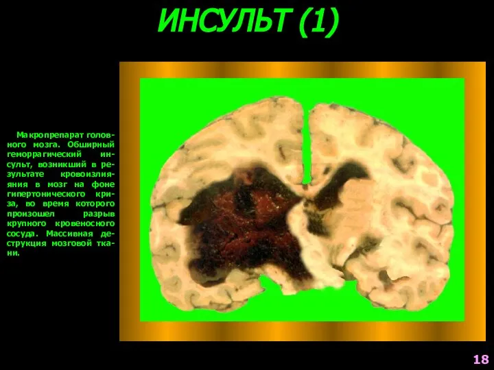 ИНСУЛЬТ (1) Макропрепарат голов-ного мозга. Обширный геморрагический ин-сульт, возникший в ре-зультате