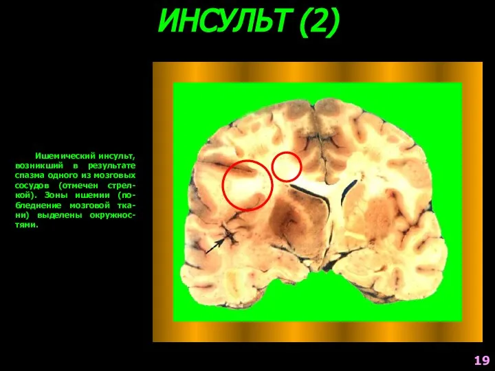 ИНСУЛЬТ (2) Ишемический инсульт, возникший в результате спазма одного из мозговых