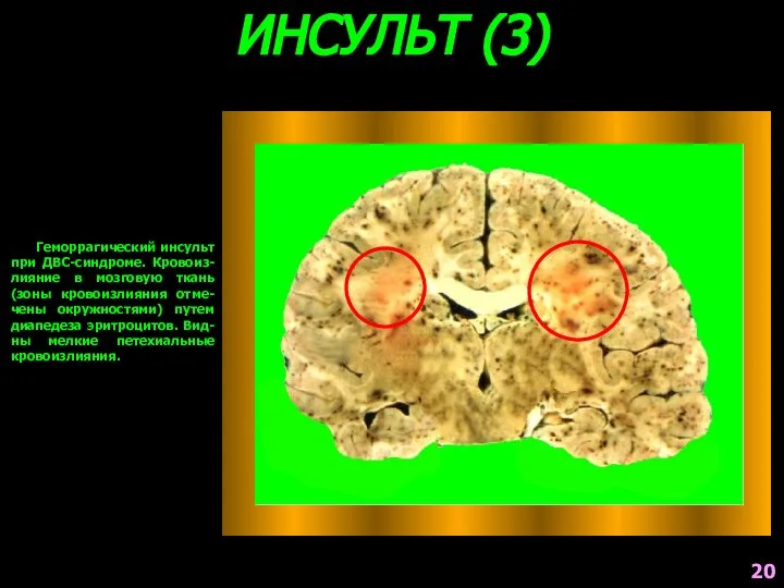 ИНСУЛЬТ (3) Геморрагический инсульт при ДВС-синдроме. Кровоиз-лияние в мозговую ткань (зоны