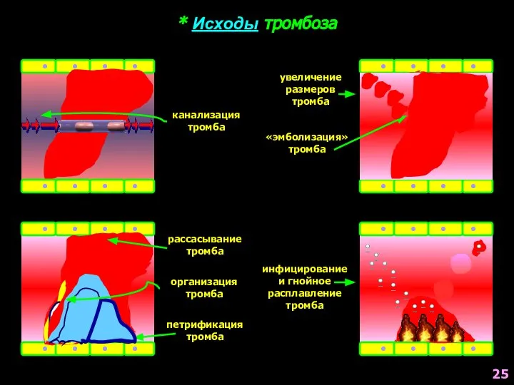 * Исходы тромбоза канализация тромба рассасывание тромба организация тромба петрификация тромба