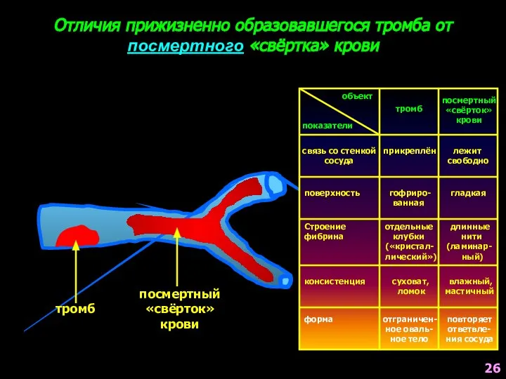 Отличия прижизненно образовавшегося тромба от посмертного «свёртка» крови тромб посмертный «свёрток»