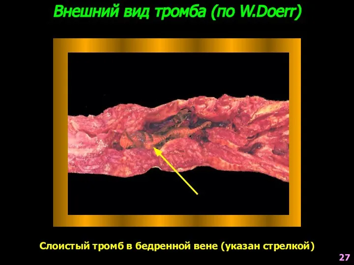 Внешний вид тромба (по W.Doerr) Слоистый тромб в бедренной вене (указан стрелкой) 27