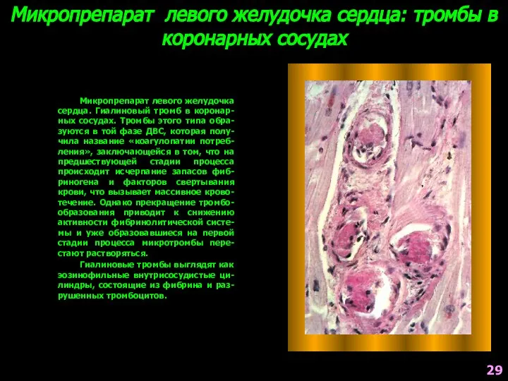 Микропрепарат левого желудочка сердца: тромбы в коронарных сосудах Микропрепарат левого желудочка