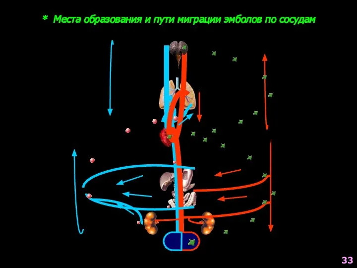 * Места образования и пути миграции эмболов по сосудам 33