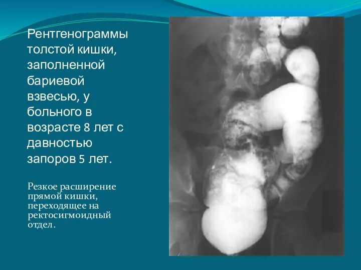 Рентгенограммы толстой кишки, заполненной бариевой взвесью, у больного в возрасте 8