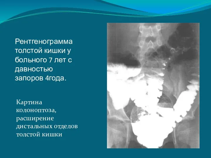 Рентгенограмма толстой кишки у больного 7 лет с давностью запоров 4года.