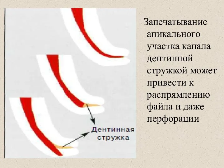 Запечатывание апикального участка канала дентинной стружкой может привести к распрямлению файла и даже перфорации