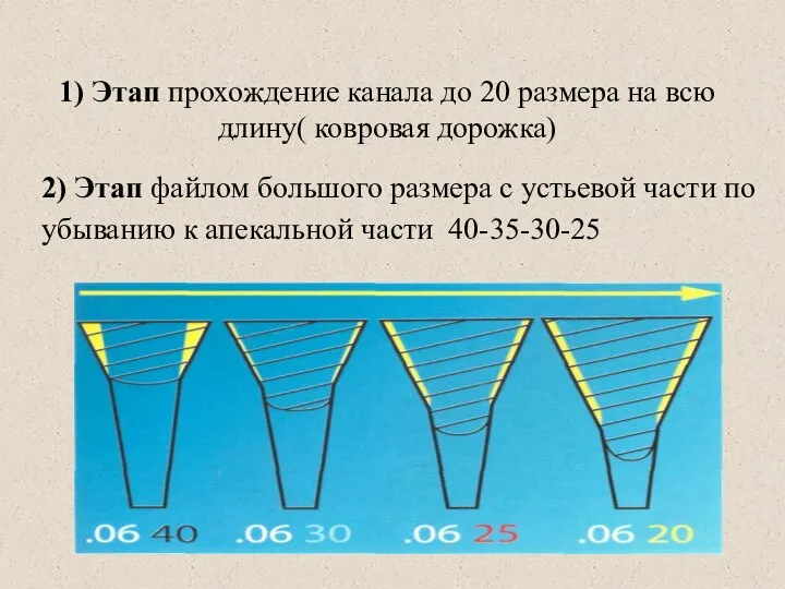 1) Этап прохождение канала до 20 размера на всю длину( ковровая