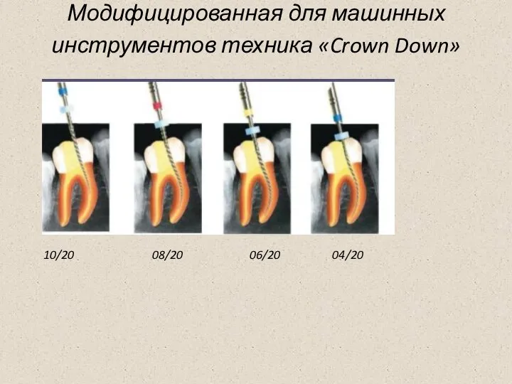 Модифицированная для машинных инструментов техника «Crown Down» 10/20 08/20 06/20 04/20