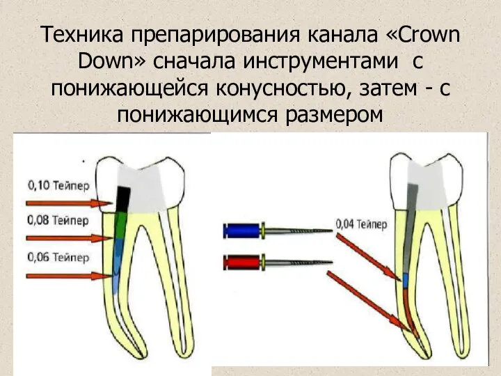 Техника препарирования канала «Crown Down» сначала инструментами с понижающейся конусностью, затем - с понижающимся размером