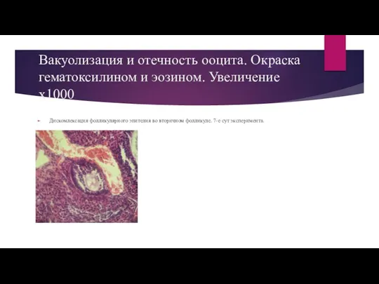 Вакуолизация и отечность ооцита. Окраска гематоксилином и эозином. Увеличение х1000 Дискомлексация