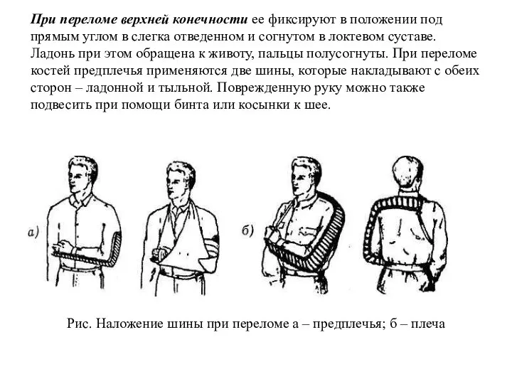 При переломе верхней конечности ее фиксируют в положении под прямым углом