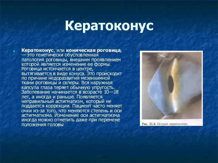 Кератоконус, или коническая роговица, — это генетически обусловленная патология роговицы, внешним