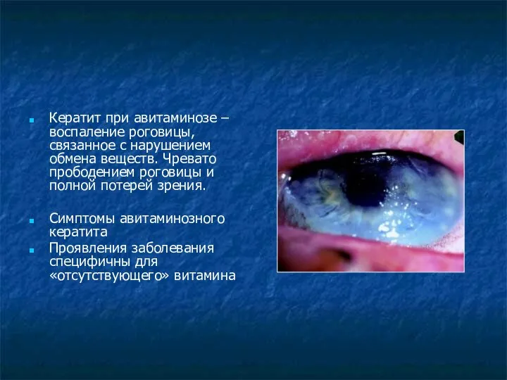 Кератит при авитаминозе – воспаление роговицы, связанное с нарушением обмена веществ.