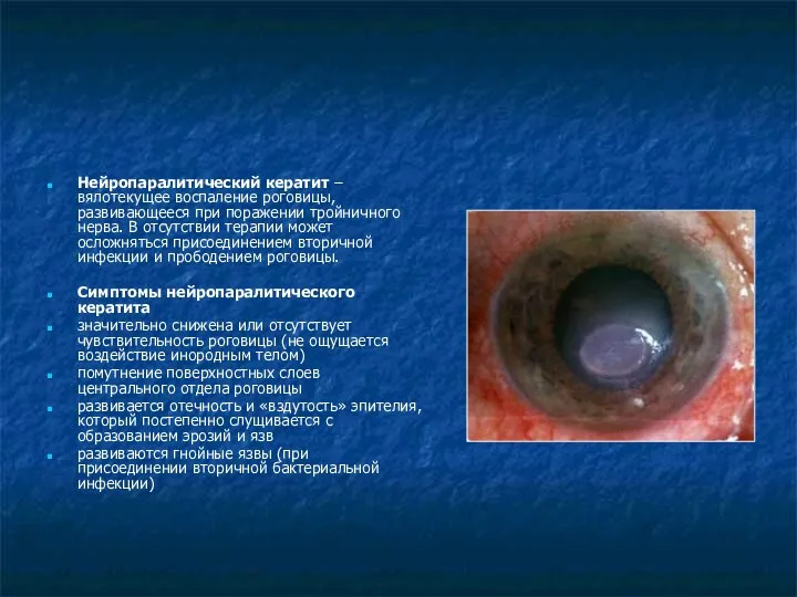Нейропаралитический кератит – вялотекущее воспаление роговицы, развивающееся при поражении тройничного нерва.
