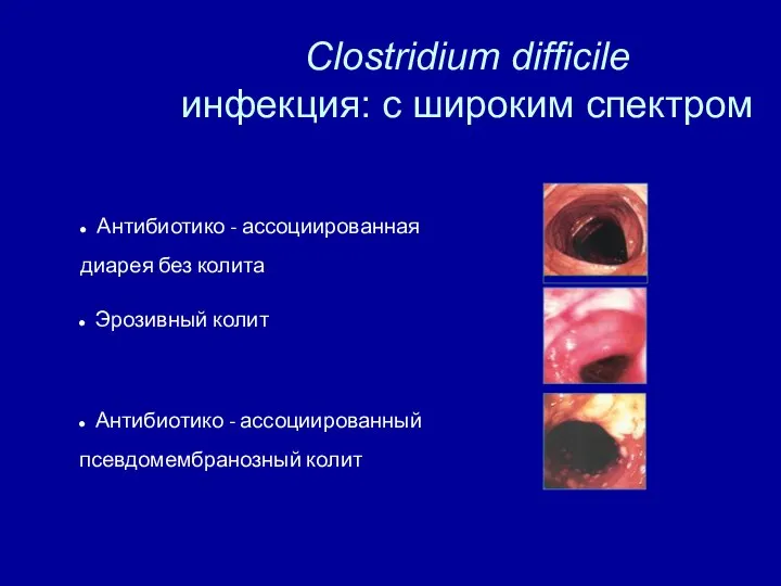 Clostridium difficile инфекция: с широким спектром Антибиотико - ассоциированная диарея без