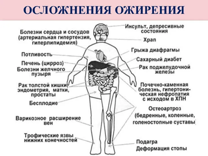 ОСЛОЖНЕНИЯ ОЖИРЕНИЯ