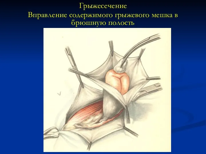 Грыжесечение Вправление содержимого грыжевого мешка в брюшную полость