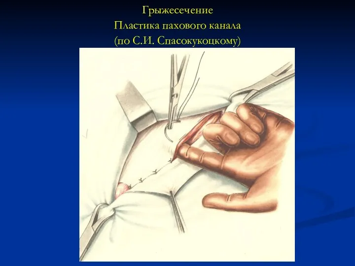 Грыжесечение Пластика пахового канала (по С.И. Спасокукоцкому)