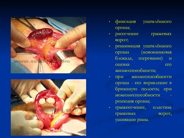 фиксация ущемлённого органа; рассечение грыжевых ворот; реанимация ущемлённого органа (новокаиновая блокада,