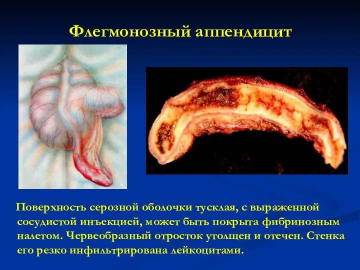 Флегмонозный аппендицит Поверхность серозной оболочки тусклая, с выраженной сосудистой инъекцией, может