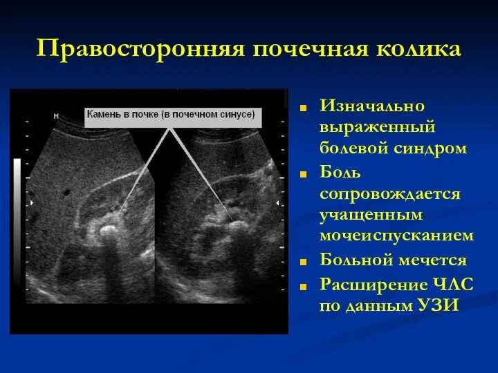 Правосторонняя почечная колика Изначально выраженный болевой синдром Боль сопровождается учащенным мочеиспусканием