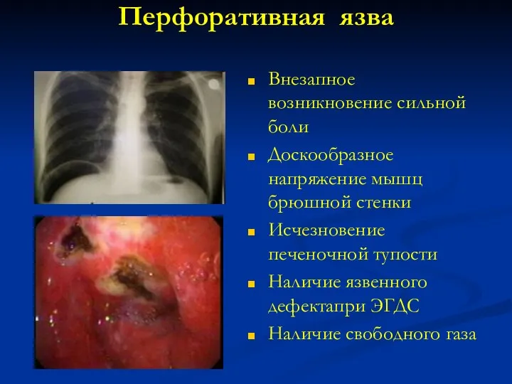 Перфоративная язва Внезапное возникновение сильной боли Доскообразное напряжение мышц брюшной стенки
