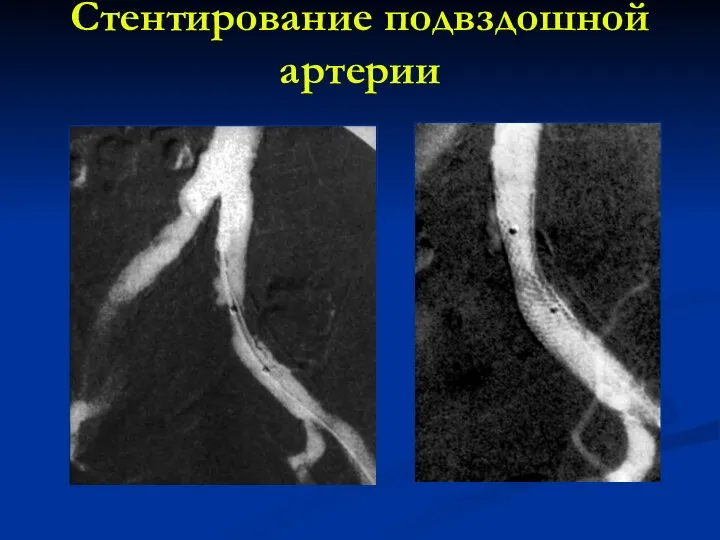 Стентирование подвздошной артерии