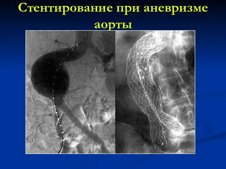 Стентирование при аневризме аорты