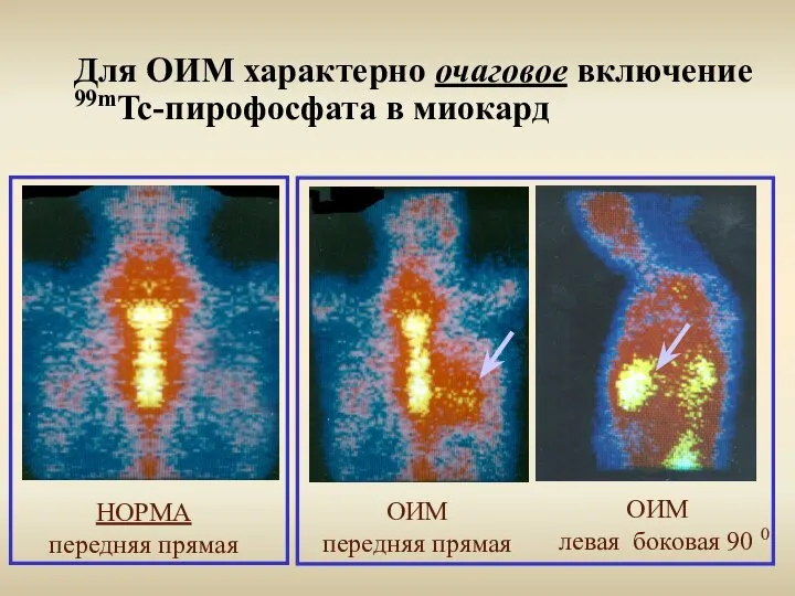 Для ОИМ характерно очаговое включение 99mTc-пирофосфата в миокард ОИМ передняя прямая