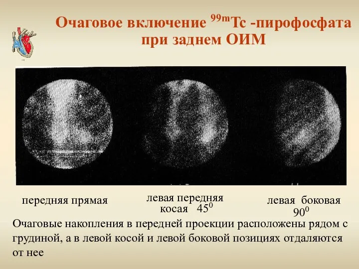 Очаговое включение 99mTc -пирофосфата при заднем ОИМ левая передняя косая 450