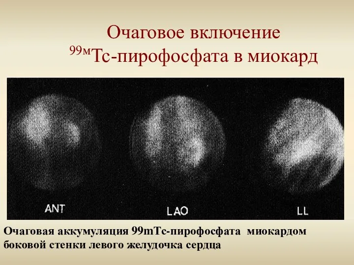 Очаговое включение 99мТс-пирофосфата в миокард Очаговая аккумуляция 99mТс-пирофосфата миокардом боковой стенки левого желудочка сердца