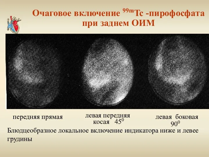 Очаговое включение 99mTc -пирофосфата при заднем ОИМ левая передняя косая 450