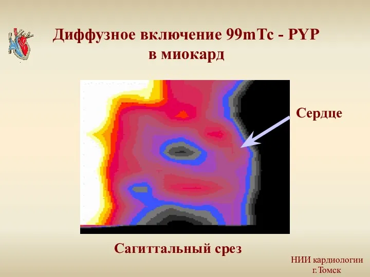 Диффузное включение 99mТс - PYP в миокард Сагиттальный срез Сердце НИИ кардиологии г.Томск