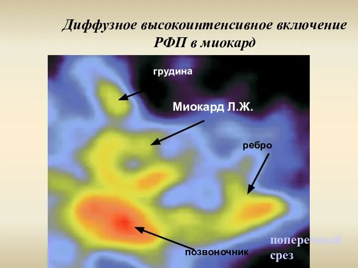 Диффузное высокоинтенсивное включение РФП в миокард поперечный срез