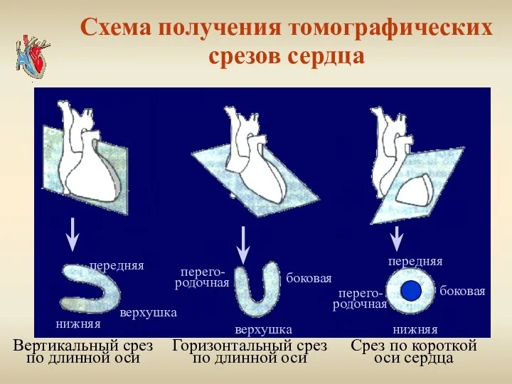 Схема получения томографических срезов сердца передняя верхушка нижняя перего- родочная верхушка