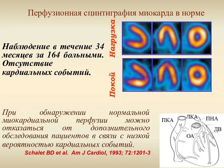 Нагрузка Покой Перфузионная сцинтиграфия миокарда в норме ПКА ПНА ЛКА ДВ