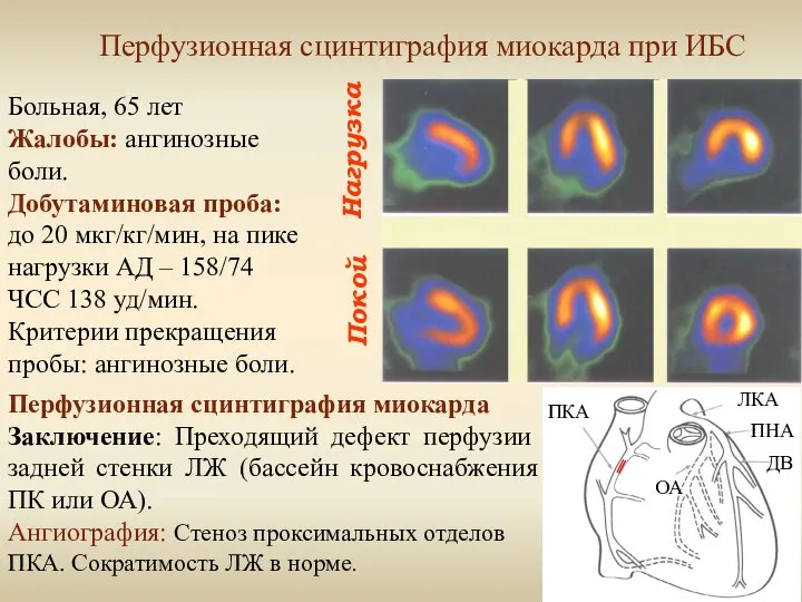 Нагрузка Покой Перфузионная сцинтиграфия миокарда при ИБС Больная, 65 лет Жалобы: