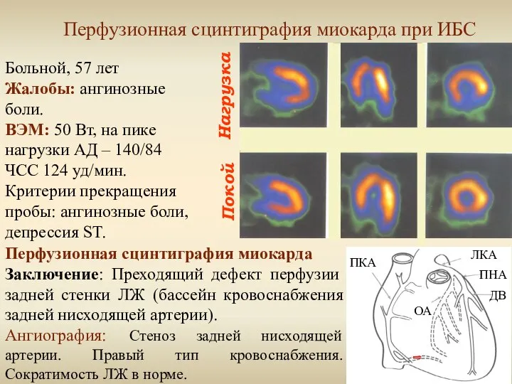 Нагрузка Покой Перфузионная сцинтиграфия миокарда при ИБС Больной, 57 лет Жалобы:
