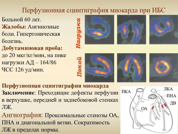 Нагрузка Покой Перфузионная сцинтиграфия миокарда при ИБС Больной 60 лет. Жалобы: