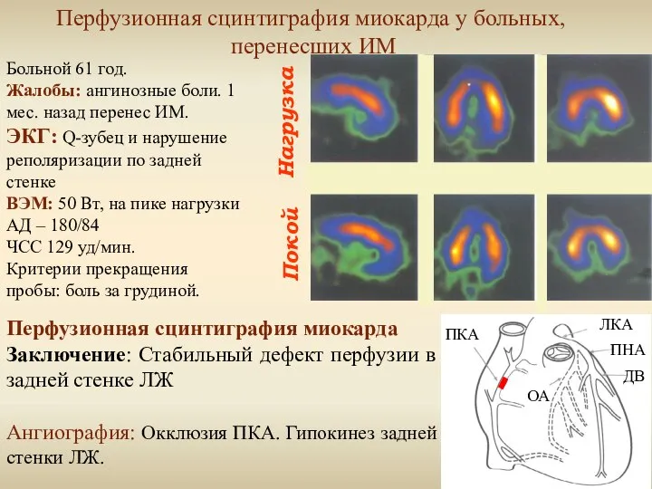 Нагрузка Покой Перфузионная сцинтиграфия миокарда у больных, перенесших ИМ Больной 61