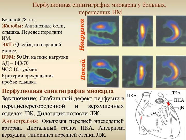 Нагрузка Покой Перфузионная сцинтиграфия миокарда у больных, перенесших ИМ Больной 78