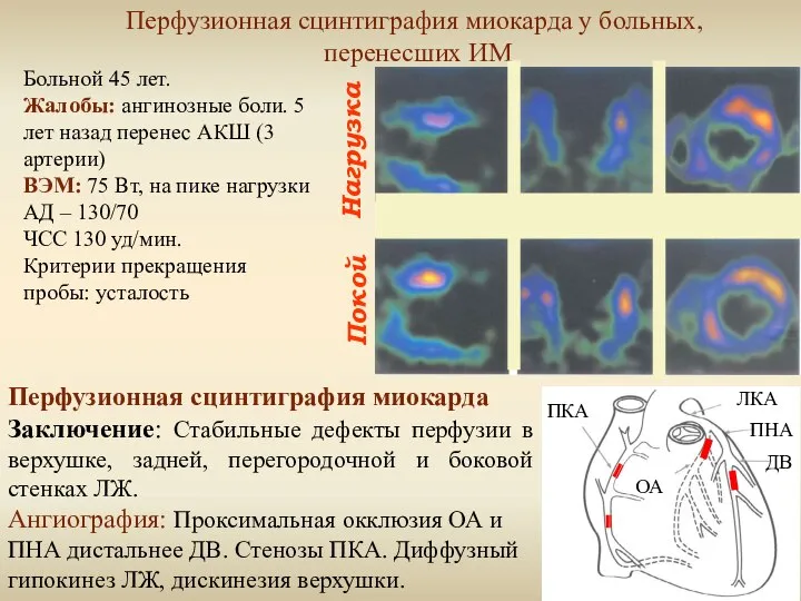 Нагрузка Покой Перфузионная сцинтиграфия миокарда у больных, перенесших ИМ Больной 45