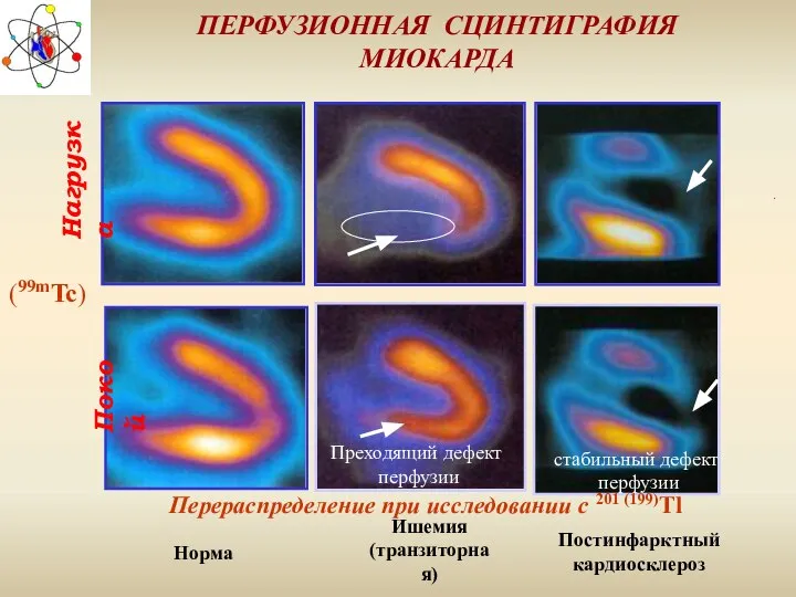 ПЕРФУЗИОННАЯ СЦИНТИГРАФИЯ МИОКАРДА Покой Нагрузка Норма Ишемия (транзиторная) Постинфарктный кардиосклероз Перераспределение