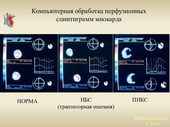 НИИ кардиологии г. Томск НОРМА ИБС (транзиторная ишемия) ПИКС Компьютерная обработка перфузионных сцинтиграмм миокарда