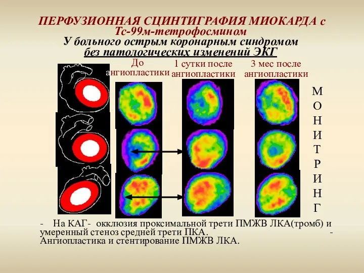 ПЕРФУЗИОННАЯ СЦИНТИГРАФИЯ МИОКАРДА с Тс-99м-тетрофосмином У больного острым коронарным синдромом без