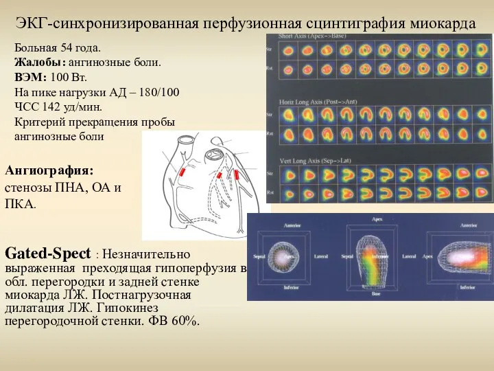 ЭКГ-синхронизированная перфузионная сцинтиграфия миокарда Больная 54 года. Жалобы: ангинозные боли. ВЭМ: