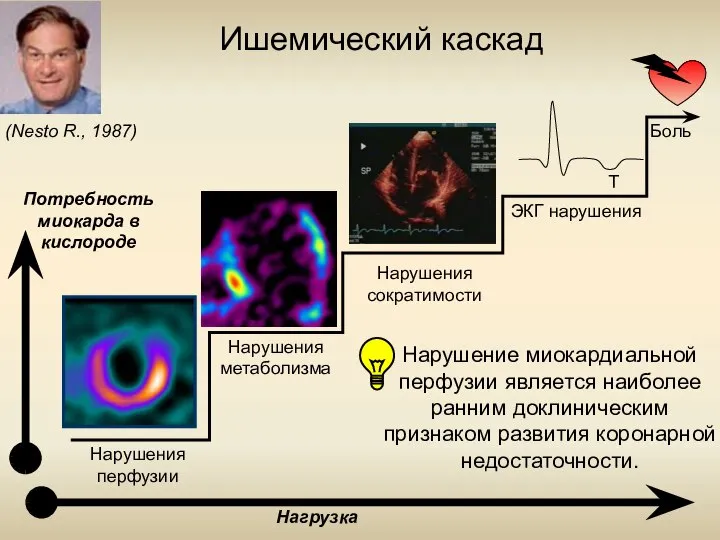 Нарушения перфузии Нарушения метаболизма Нарушения сократимости ЭКГ нарушения Боль Ишемический каскад