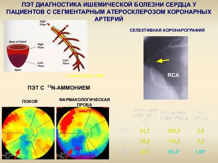 ПЭТ ДИАГНОСТИКА ИШЕМИЧЕСКОЙ БОЛЕЗНИ СЕРДЦА У ПАЦИЕНТОВ С СЕГМЕНТАРНЫМ АТЕРОСКЛЕРОЗОМ КОРОНАРНЫХ